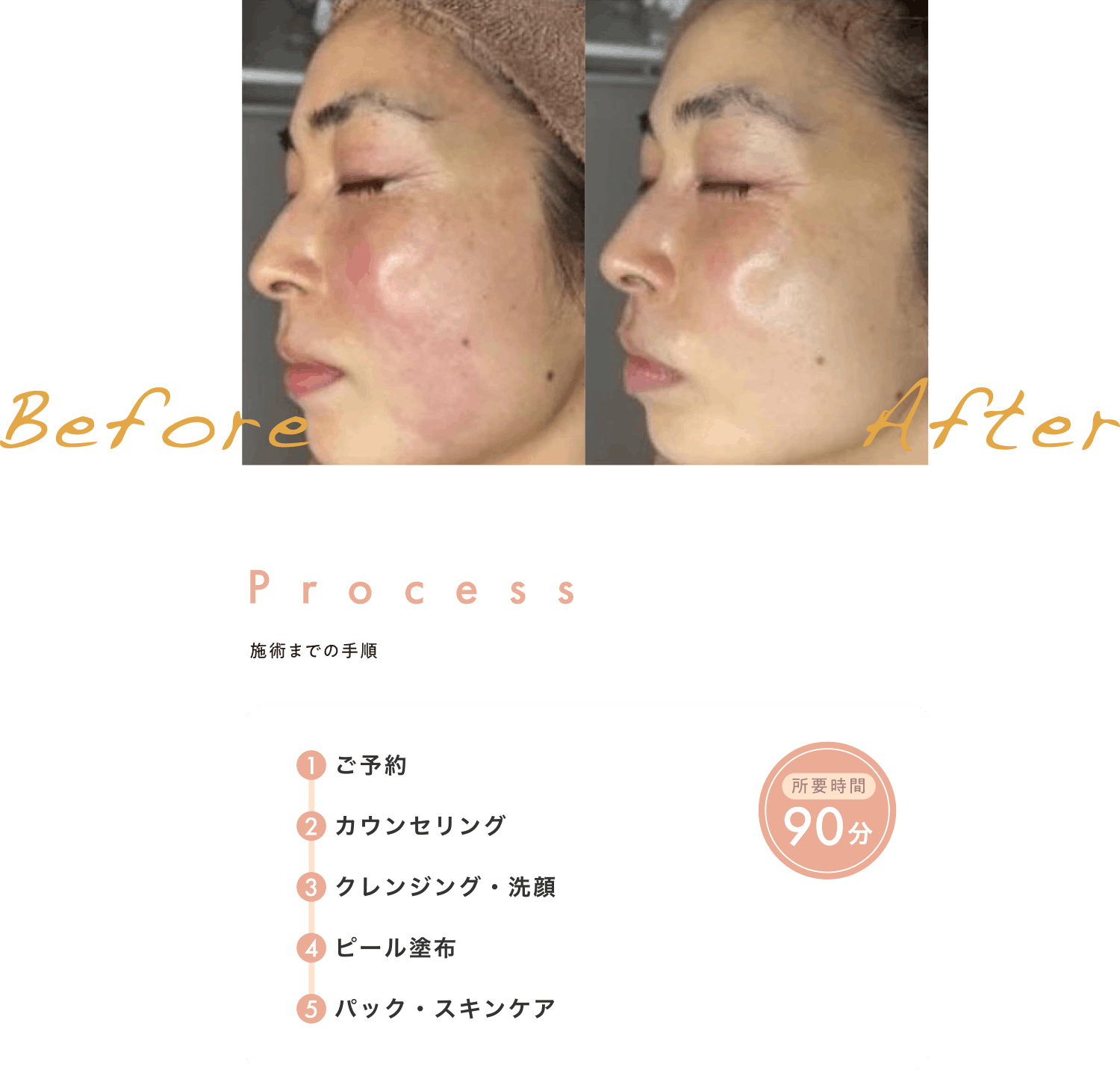 施術までの手順